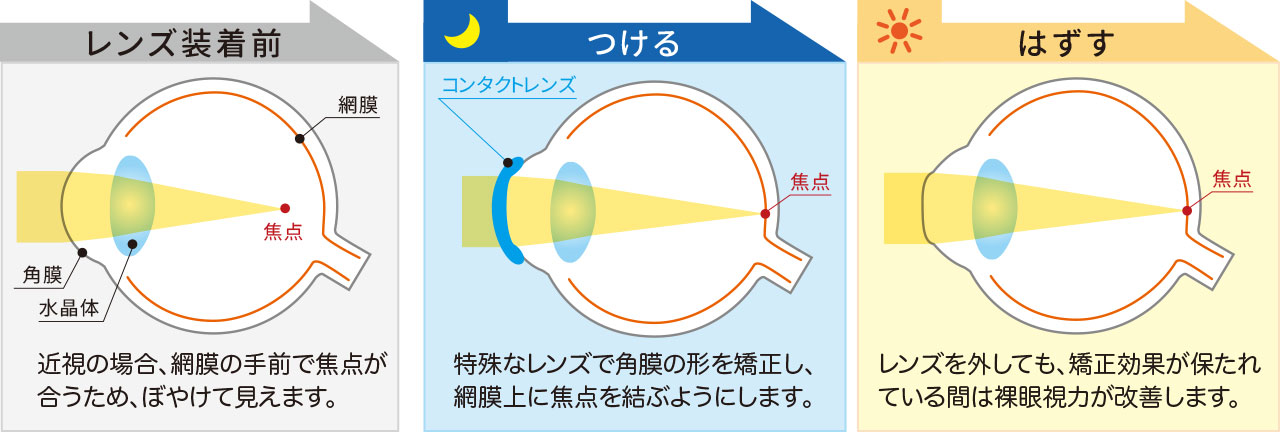 オルソケラトロジー装着前・つけた時・はずした時